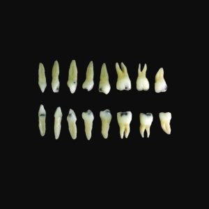 Lower Teeth With Caries