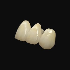 Zirconia Bridge With Ceramics